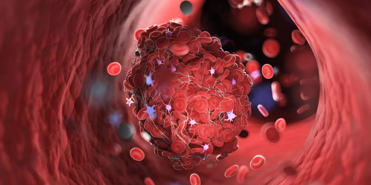 llustration of cholesterol build-up in a blood vessel, highlighting the importance of understanding how to reduce cholesterol for cardiovascular health.